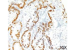 IHC staining of human lung adenocarcinoma (10X) with TTF-1 antibody (8G7G3/1). (TTF1 anticorps)