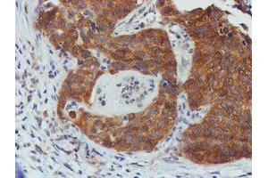 Immunohistochemical staining of paraffin-embedded Carcinoma of Human lung tissue using anti-TULP3 mouse monoclonal antibody. (TULP3 anticorps)