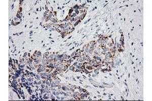 Immunohistochemical staining of paraffin-embedded Adenocarcinoma of Human breast tissue using anti-PPM1B mouse monoclonal antibody. (PPM1B anticorps)