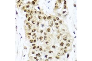 Immunohistochemistry of paraffin-embedded human lung cancer using TET2 antibody (ABIN6133019, ABIN6149017, ABIN6149019 and ABIN6221336) at dilution of 1:100 (40x lens).