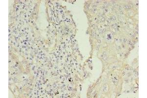 Immunohistochemistry of paraffin-embedded human lung cancer using ABIN7157464 at dilution of 1:100