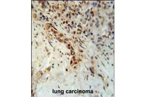 DCLRE1C Antibody immunohistochemistry analysis in formalin fixed and paraffin embedded human lung carcinoma followed by peroxidase conjugation of the secondary antibody and DAB staining. (DCLRE1C anticorps  (N-Term))