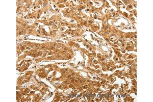 Immunohistochemistry of Human lung cancer using TXN Polyclonal Antibody at dilution of 1:40 (TXN anticorps)