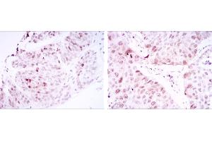 Immunohistochemical analysis of paraffin-embedded ovarian cancer tissues (left) and lung cancer tissues (right) using CDK1 mouse mAb with DAB staining. (CDK1 anticorps)