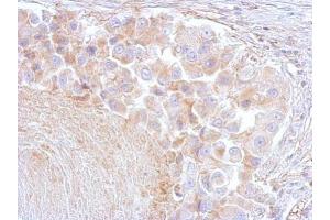 IHC-P Image Annexin VI antibody [C2C3], C-term detects ANXA6 protein at cytosol on human breast by immunohistochemical analysis.
