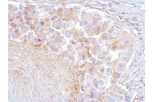 IHC-P Image Annexin VI antibody [C2C3], C-term detects ANXA6 protein at cytosol on human breast by immunohistochemical analysis. (ANXA6 anticorps  (C-Term))