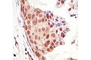 IHC analysis of FFPE human breast carcinoma tissue stained with the SUMO antibody (SUMO1 anticorps  (AA 55-86))