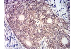 Immunohistochemical analysis of paraffin-embedded cervical cancer tissues using KAT7 mouse mAb with DAB staining.