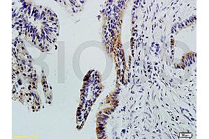 Formalin-fixed and paraffin-embedded : human colon carcinoma labeled with Rabbit Anti-Integrin ? (ITGAV/ITGB1 anticorps)