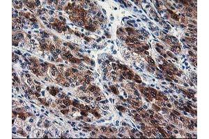 Immunohistochemical staining of paraffin-embedded Carcinoma of Human liver tissue using anti-SEC14L2 mouse monoclonal antibody. (SEC14L2 anticorps)