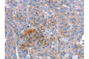 The image on the left is immunohistochemistry of paraffin-embedded Human breast cancer tissue using ABIN7192628(SPATA5L1 Antibody) at dilution 1/20, on the right is treated with synthetic peptide. (SPATA5L1 anticorps)