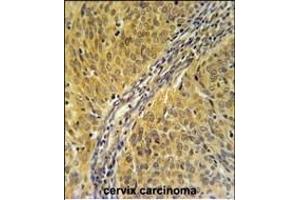 DYNC1LI2 Antibody (Center) (ABIN651669 and ABIN2840352) immunohistochemistry analysis in formalin fixed and paraffin embedded human cervix carcinoma followed by peroxidase conjugation of the secondary antibody and DAB staining.