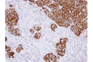 IHC-P Image Immunohistochemical analysis of paraffin-embedded SW480 xenograft , using alpha Glucosidase II, antibody at 1:500 dilution.