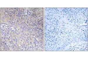 Immunohistochemistry analysis of paraffin-embedded human cervix carcinoma tissue, using MRPL11 Antibody. (MRPL11 anticorps  (AA 21-70))