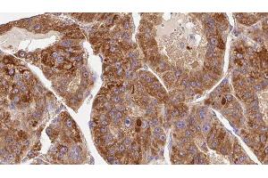 ABIN6276768 at 1/100 staining Human liver cancer tissue by IHC-P. (KIR3DL1 anticorps  (Internal Region))