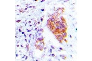 Immunohistochemical analysis of CDC37 (pS13) staining in human lung cancer formalin fixed paraffin embedded tissue section.