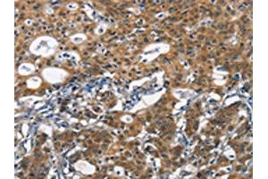 The image on the left is immunohistochemistry of paraffin-embedded Human gastic cancer tissue using ABIN7190434(DCC Antibody) at dilution 1/70, on the right is treated with synthetic peptide. (DCC anticorps)