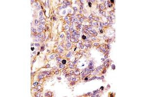 (ABIN659120 and ABIN2843760) staining CD44 in human lung adenocarcinoma tissue sections by Immunohistochemistry (IHC-P - paraformaldehyde-fixed, paraffin-embedded sections). (CD44 anticorps)