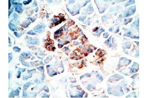 Human pancreas cancer tissue was stained by Rabbit Anti-Oxyntomodulin (H,M,R) Antibody (OXM anticorps)