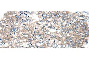 Immunohistochemistry of paraffin-embedded Human liver cancer tissue using BBS12 Polyclonal Antibody at dilution of 1:50(x200) (BBS12 anticorps)