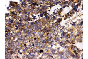 Anti- LAR Picoband antibody, IHC(P) IHC(P): Human Lung Cancer Tissue