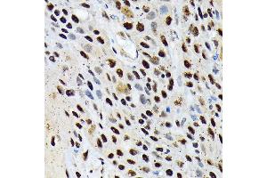 Immunohistochemistry of paraffin-embedded human esophageal cancer using ENT2/SLC29 Rabbit mAb (ABIN7270448) at dilution of 1:100 (40x lens).