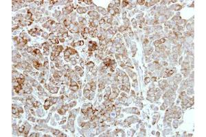 IHC-P Image Immunohistochemical analysis of paraffin-embedded MDAMB468 xenograft, using PDE1A, antibody at 1:500 dilution.