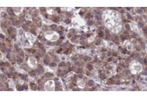 ABIN6273919 at 1/100 staining Human liver cancer tissue by IHC-P.