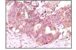Immunohistochemical analysis of paraffin-embedded human recturn adenocarcinoma tissue showing cytoplasmic localization using FGF2 antibody with DAB staining.