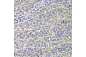 Immunohistochemistry of paraffin-embedded mouse cancer using STAT4 antibody at dilution of 1:100 (x400 lens).