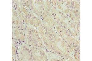 Immunohistochemistry of paraffin-embedded human gastric cancer using ABIN7144962 at dilution of 1:100 (DDX11 anticorps  (AA 1-220))