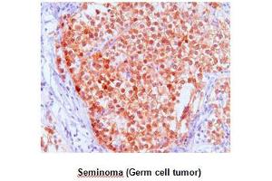 Paraffin embedded sections of Seminoma (Germ cell tumor) tissue were incubated with anti-human FKBP4 (1:50) for 2 hours at room temperature.