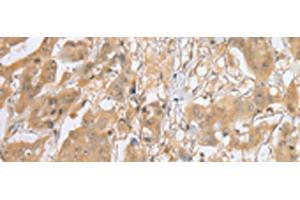 Immunohistochemistry of paraffin-embedded Human breast cancer tissue using MOB4 Polyclonal Antibody at dilution of 1:25(x200) (MOBKL3 anticorps)