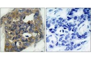 Immunohistochemistry analysis of paraffin-embedded human breast carcinoma, using ASK1 (Phospho-Ser966) Antibody. (ASK1 anticorps  (pSer966))