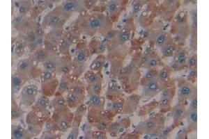 Detection of MBL in Human Liver cancer Tissue using Polyclonal Antibody to Mannose Binding Lectin (MBL)