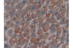 Detection of MBL in Human Liver cancer Tissue using Polyclonal Antibody to Mannose Binding Lectin (MBL) (MBL2 anticorps  (AA 130-248))