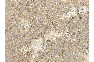 ABIN6256612 and ABIN6267176 at 1/100 staining human melanoma by IHC-P.