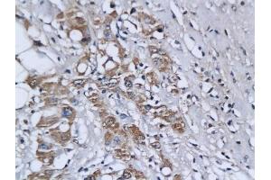 Formalin-fixed and paraffin embedded human breast cancer labeled with Anti-Ets1/ETS-1 Polyclonal Antibody, Unconjugated (ABIN674424) followed by conjugation to the secondary antibody and DAB staining
