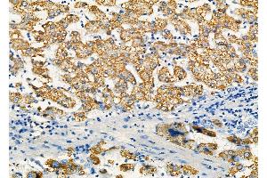 ABIN6259881 and ABIN6277303 at 1/100 staining Human liver cancer and adjacent normal tissues by IHC-P.