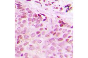 Immunohistochemical analysis of Separase (pS801) staining in human breast cancer formalin fixed paraffin embedded tissue section.