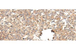 Immunohistochemistry of paraffin-embedded Human esophagus cancer tissue using CACNG5 Polyclonal Antibody at dilution of 1:50(x200) (CACNG5 anticorps)