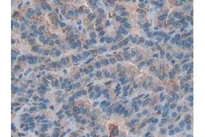 DAB staining on IHC-P; Samples: Human Thyroid cancer Tissue (Cathepsin D anticorps  (AA 169-408))