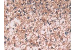 Detection of IL12A in Human Glioma Tissue using Monoclonal Antibody to Interleukin 12A (IL12A)