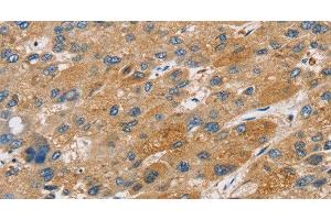 Immunohistochemistry of paraffin-embedded Human liver cancer tissue using ST18 Polyclonal Antibody at dilution 1:50 (ST18 anticorps)