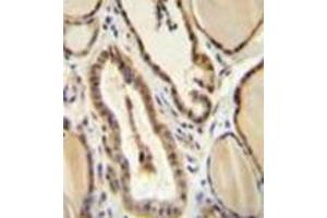 Immunohistochemistry analysis in formalin fixed and paraffin embedded human thyroid tissue reacted with GUCY2D / GUCY2D / RETGC1 Antibody (Center) followed which was peroxidase conjugated to the secondary antibody and followed by DAB staining. (GUCY2D anticorps  (Middle Region))