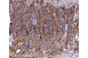 Immunohistochemistry analysis of RANTES antibody in paraffin-embedded human lung carcinoma tissue (CCL5 anticorps  (Internal Region))