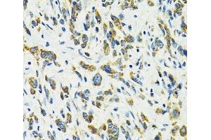 Immunohistochemistry of paraffin-embedded Human gastric cancer using SLC25A11 Polyclonal Antibody at dilution of 1:100 (40x lens).