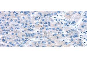 Immunohistochemistry of paraffin-embedded Human liver cancer using UCP2 Polyclonal Antibody at dilution of 1/20 (UCP2 anticorps)