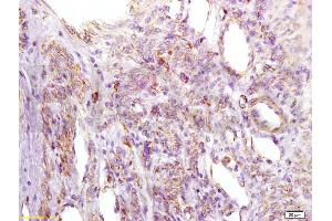 Formalin-fixed and paraffin embedded human cervical carcinoma labeled with Anti-IGFBP2 Polyclonal Antibody, Unconjugated (ABIN737781) at 1:200 followed by conjugation to the secondary antibody and DAB staining.