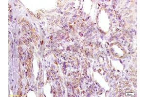 Formalin-fixed and paraffin embedded human cervical carcinoma labeled with Anti-IGFBP2 Polyclonal Antibody, Unconjugated (ABIN737781) at 1:200 followed by conjugation to the secondary antibody and DAB staining. (IGFBP2 anticorps  (AA 101-200))